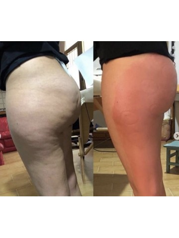 MASSAGGIATORE CUPPING /INFRAROSSI/ ELETTROTERAPIA